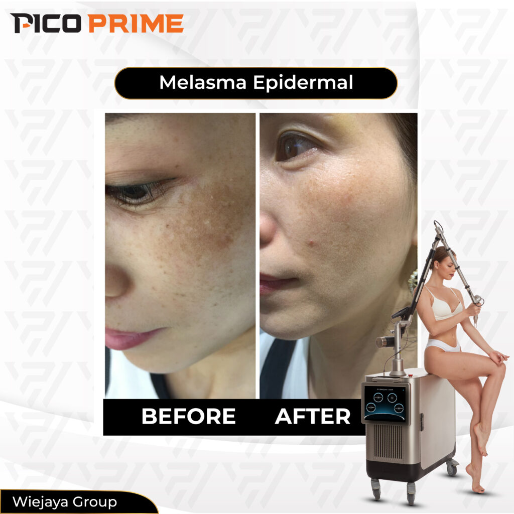pico laser, pico laser adalah, pico laser treatment, harga pico laser, manfaat pico laser, laser pico adalah, pico laser untuk apa, pico laser before and after, apa itu pico laser