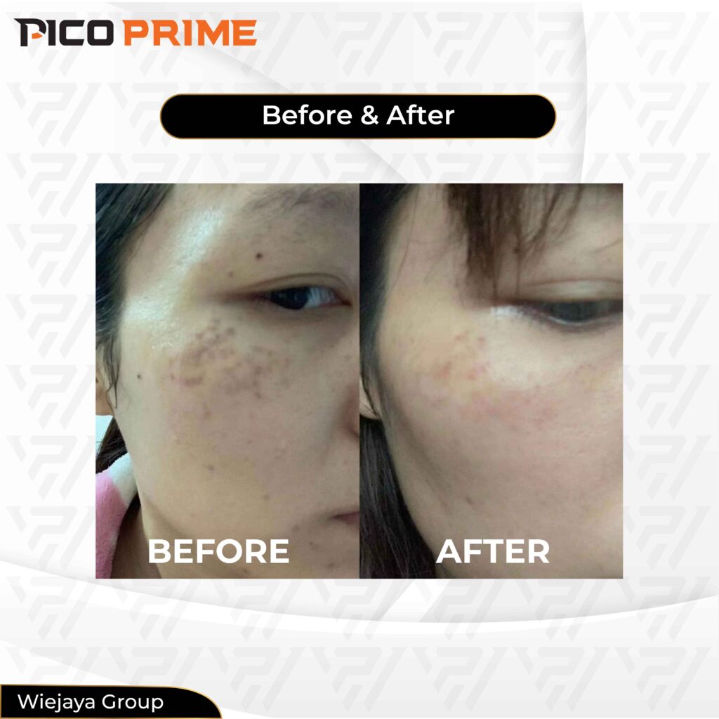 pico laser before and after pico laser before and after