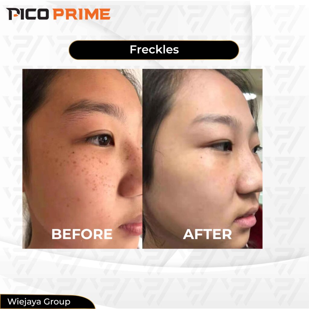 pico laser treatment, pico laser before and after pico laser treatment, pico laser before and after