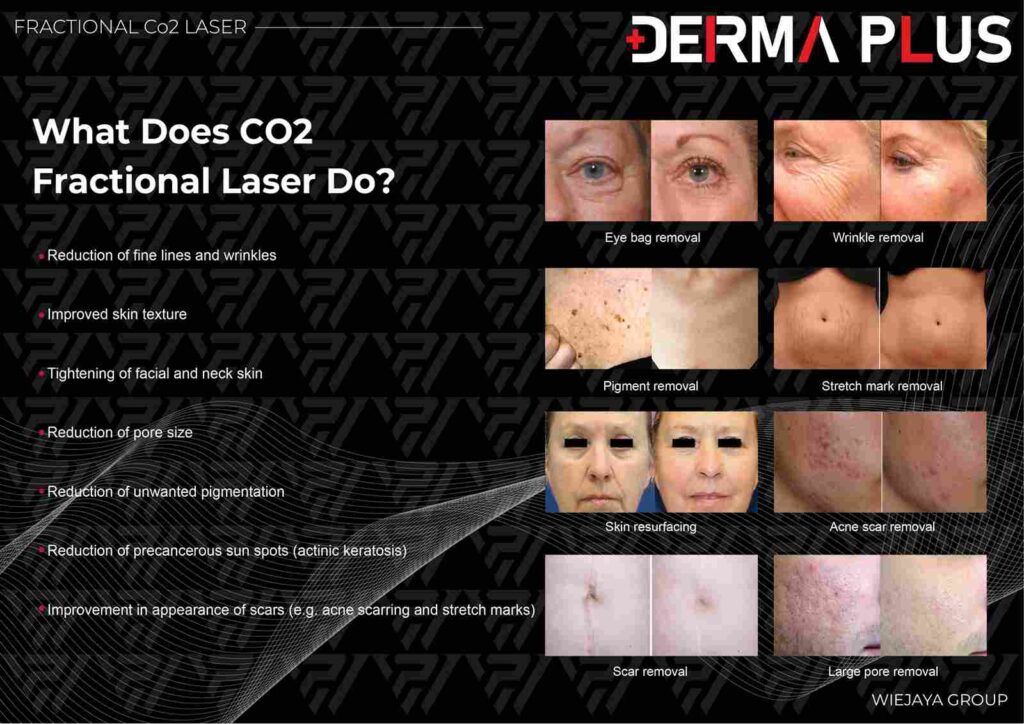 co2 fractional-after-treatment-scaled_11zon
