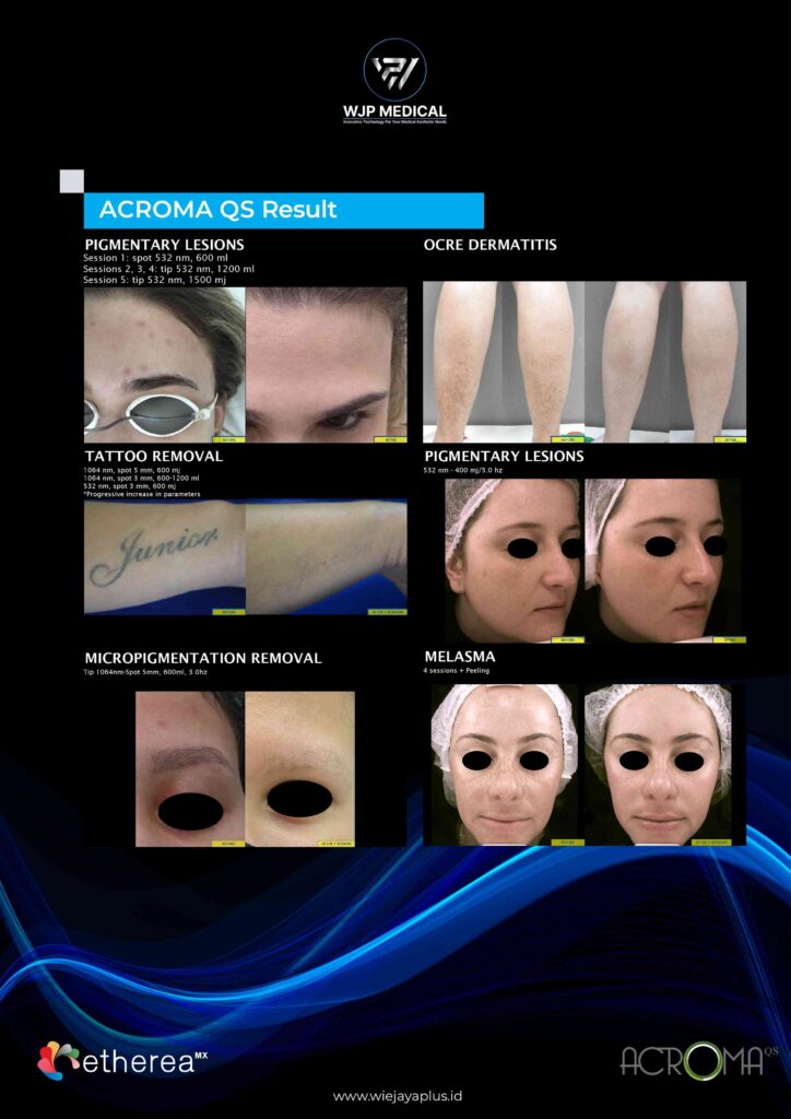 ACROMA-QS® pada etherea mx mampu mengatasi melasma, lentigo, dan hiperpigmentasi pasca-inflamasi secara efektif