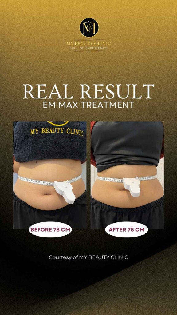 treatment untuk perut sixpack