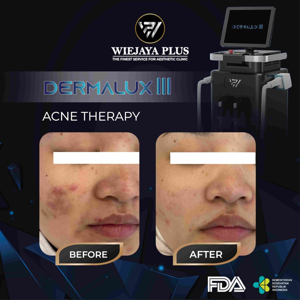 DERMALUX III-ACNE THERAPY-03_11zon