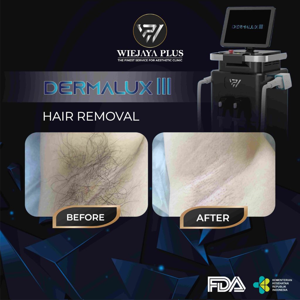 DERMALUX III-HAIR REMOVAL-05 (1)_11zon