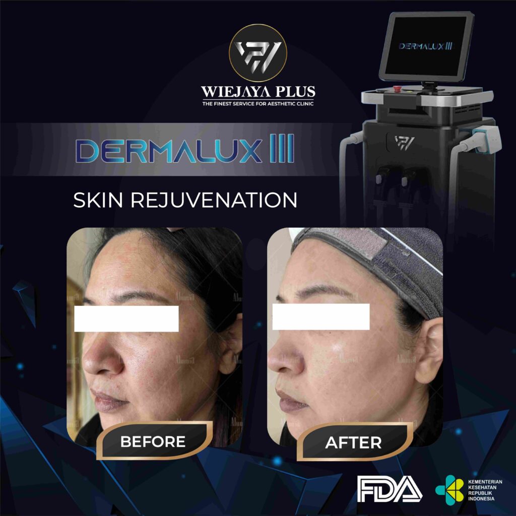DERMALUX III-SKIN REJUVENATION-04_11zon