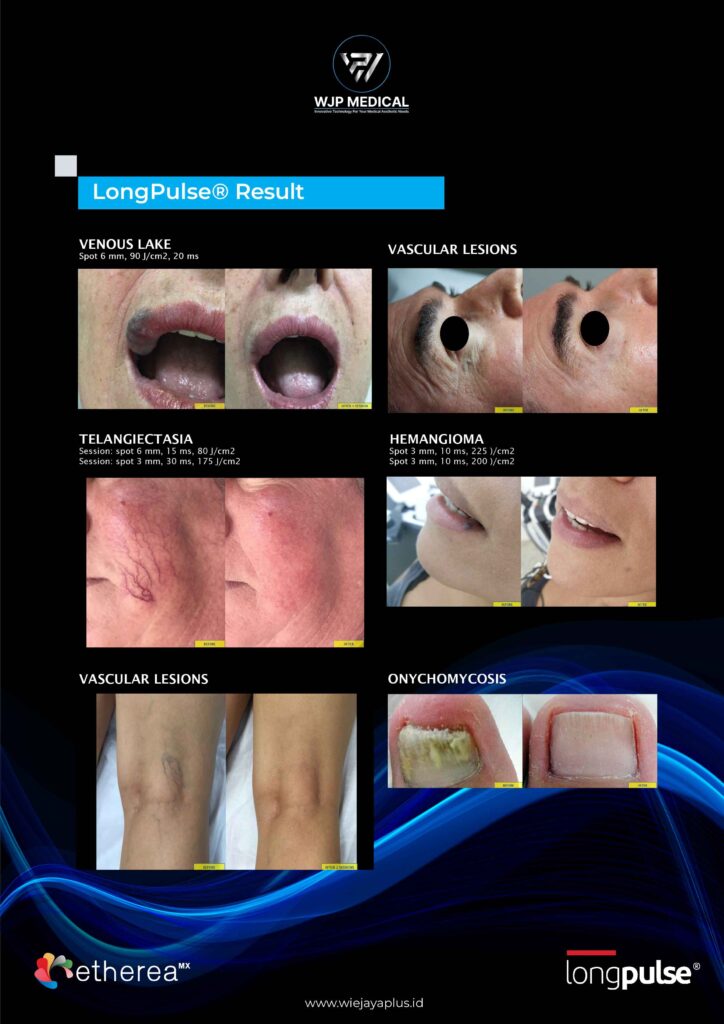 laser pico untuk treatment